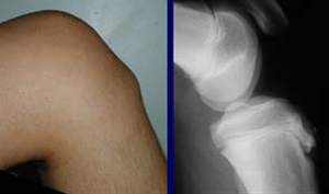 Osgood Schlatter hay bệnh viêm lồi củ trước xương chầy